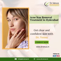 Acne scar removal treatment in Hyderabad